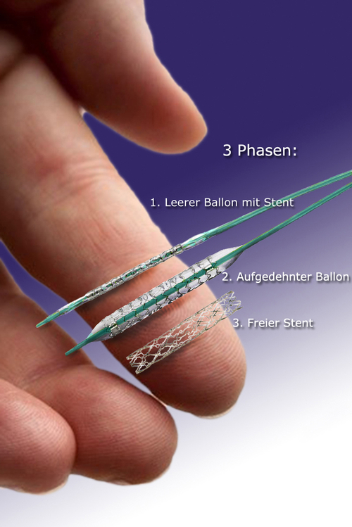 Universit tsklinikum Giessen Und Marburg PCI Universit tsklinikum Giessen Und Marburg PCI