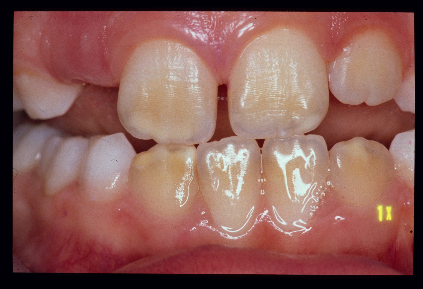 Molar Incisor Hypomineralisation MIH Universit tsklinikum Giessen 