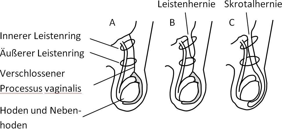 Ukgm Giessen Marburg Leistenbruch 