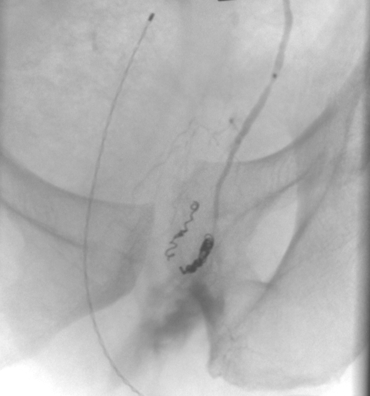 Angiographie A. pudenda nach Coiling