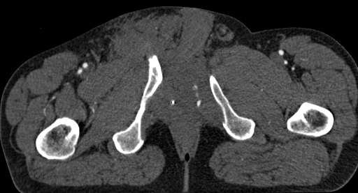 Blutung der A. pudenda interna im CT