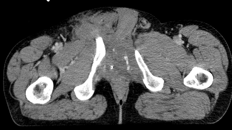 Blutung A. pudenda spätvenöse Phase CT