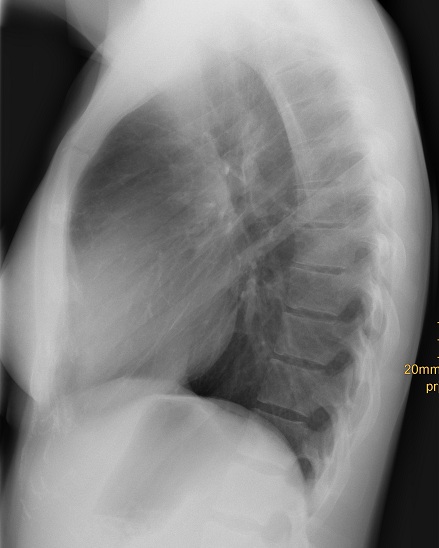 Röntgenthorax seitlich Normalbefund