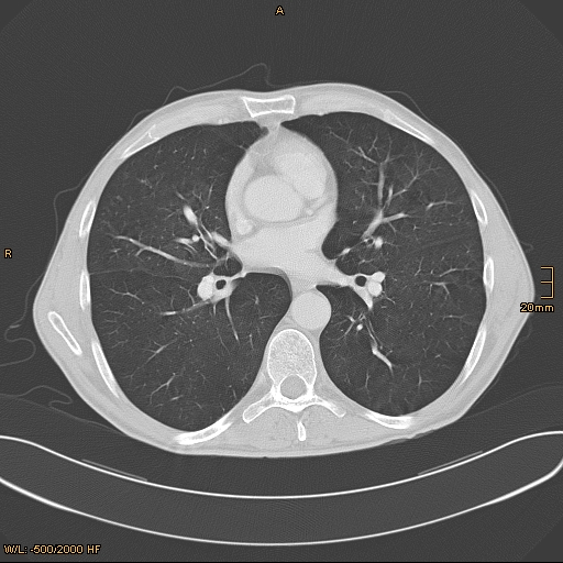 CT-Thorax Normalbefund