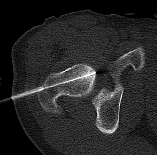 Osteoid Osteom